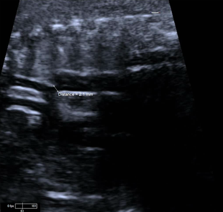 Aortic Arch | Pediatric Echocardiography