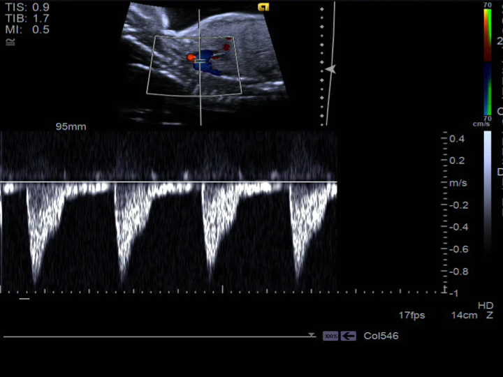 Fetal Echo Images: Aortic arch | Pediatric Echocardiography