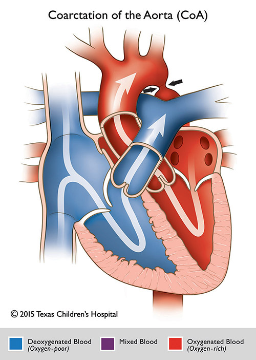 Coarctation of the Aorta | Pediatric Echocardiography