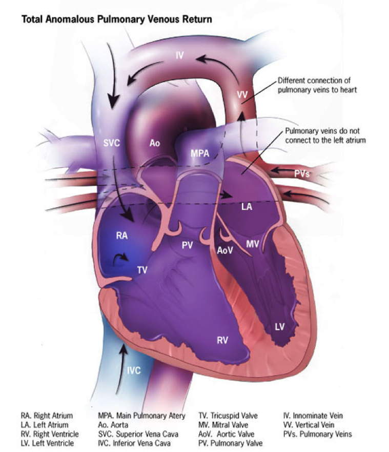 Supracardiac Total Anomalous Pulmonary Venous Return ...