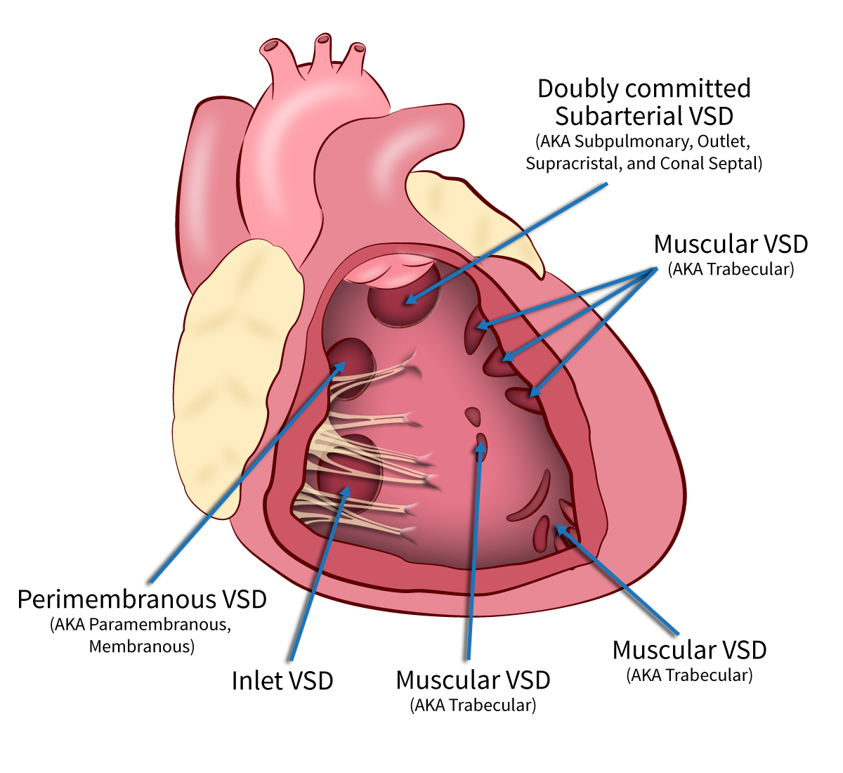 Ventricular Septal Defect Pediatric Echocardiography